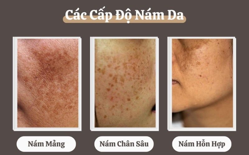 Có nên peel da trị nám tại nhà không phụ thuộc vào nhiều yếu tố như tình trạng da nám