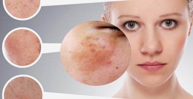 Những dấu hiệu da bị nám nội tiết thường dễ quan sát bằng mắt thường