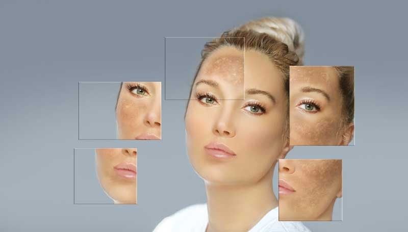 Điều trị nám có cần kiêng gì không? giải đáp các thắc mắc khi trị nám
