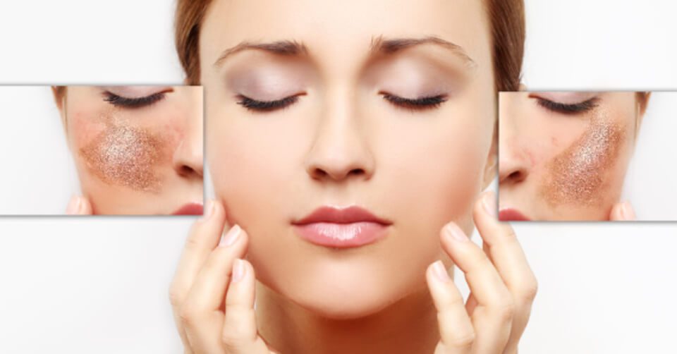 Điều trị nám da giá bao nhiêu tiền phụ thuộc vào phương pháp trị nám