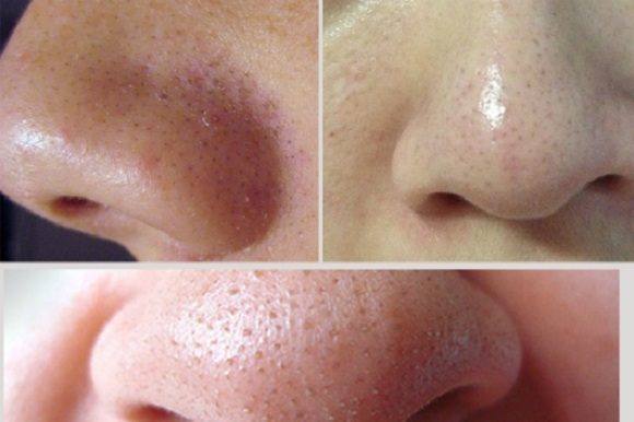 Một số lưu ý khi sử dụng kem lột mụn đầu đen