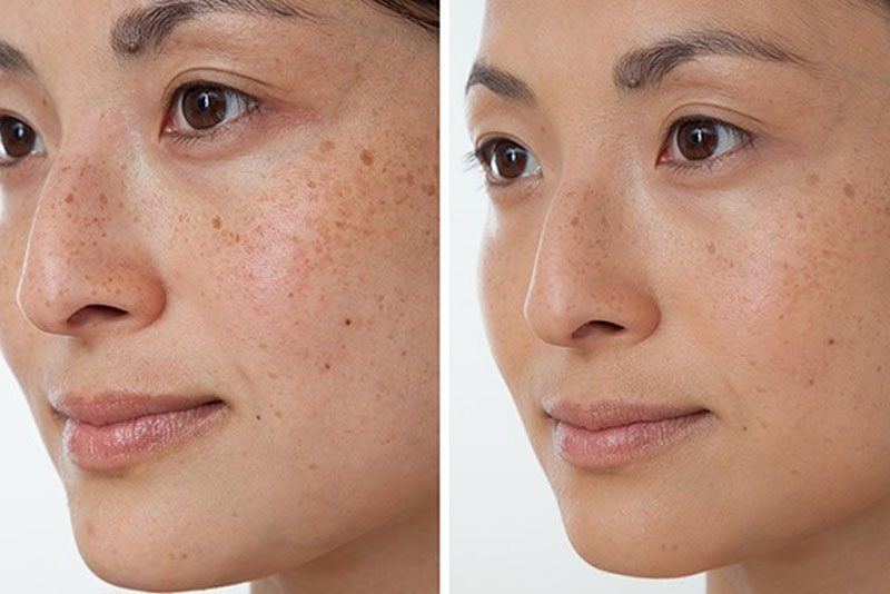 Laser trị nám có hết vĩnh viễn không phụ thuộc vào nhiều yếu tố khác nhau