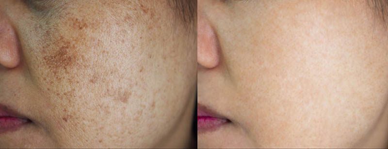 Giải đáp chi tiết laser trị nám có hết vĩnh viễn không