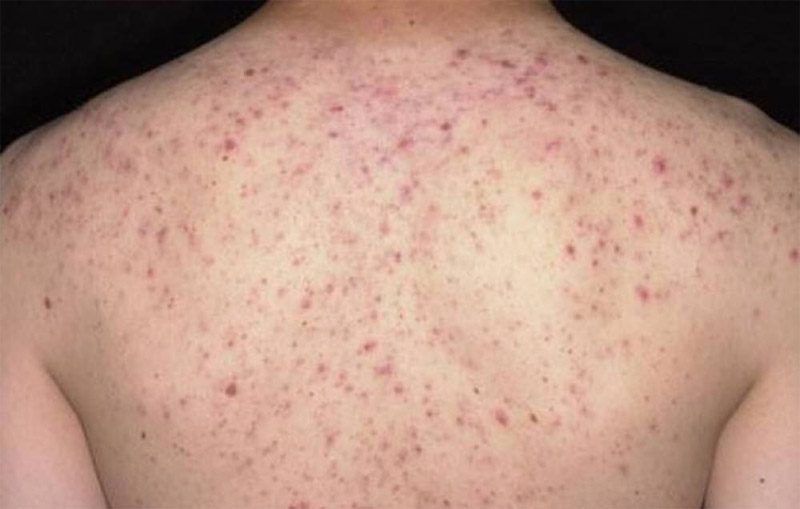 Điều trị viêm nang lông là quá trình đòi hỏi sự kiên trì và hiểu rõ về cơ địa da. Sử dụng Medimix điều trị viêm nang lông đúng cách kết hợp với sản phẩm chăm sóc chuyên sâu từ Dr-Spiller.vn sẽ giúp cải thiện đáng kể tình trạng da và ngăn ngừa tái phát.