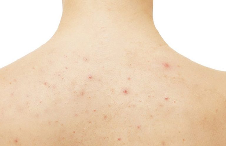 Làm thế nào để kiểm soát mụn ẩn ở lưng hiệu quả