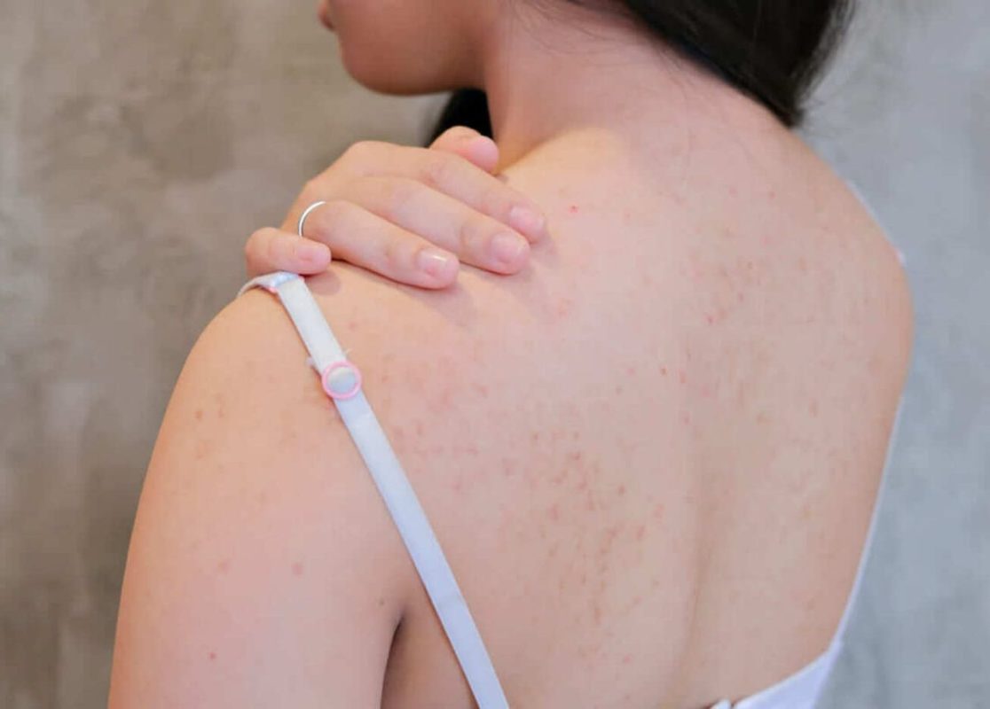 Những lưu ý khi trị mụn ẩn ở lưng