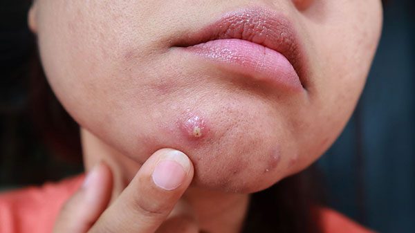 Giải đáp các thắc mắc chi tiết về mụn mủ ở cằm