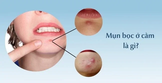 Mụn mủ ở cằm khiến bạn khó chịu và kém tự tin