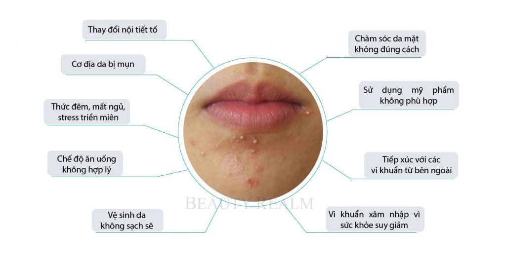 Những nguyên nhân khiến tình trạng mụn mủ ở cằm trở nên nghiêm trọng hơn