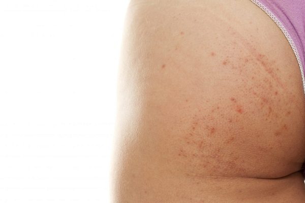 Tìm hiểu nguyên nhân để có cách trị mụn thâm ở mông hiệu quả