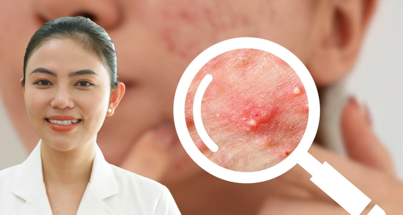 Làm thế nào để phân biệt sản phẩm trị mụn tuổi dậy thì nữ tại nhà tự nhiên thật sự và sản phẩm chỉ “gắn mác” thiên nhiên?