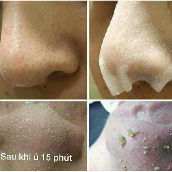Ủ mụn đầu đen giúp làm mềm, mở lỗ chân lông lấy nhân mụn, bụi bẩn nhanh chóng hơn