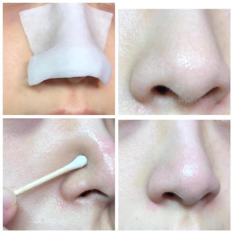 Những lưu ý khi ủ mụn đầu đen