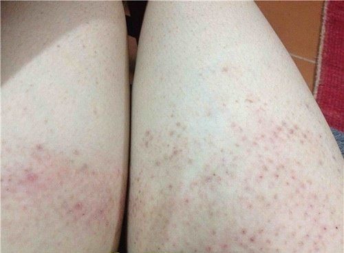 Đặc điểm lâm sàng của triệu chứng viêm nang lông hồng ban hình mạng lưới