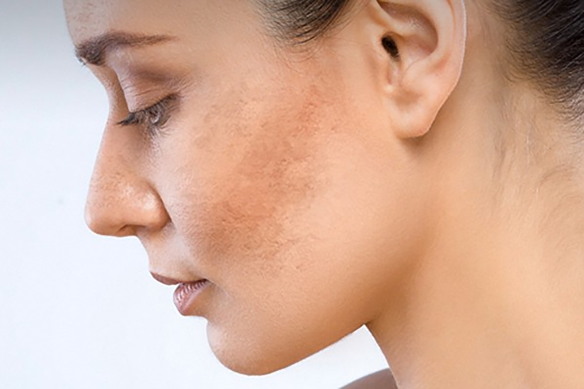 Viên Uống Trị Nám Da Tốt Nhất phải đảm bảo đáp ứng được các tiêu chí sau