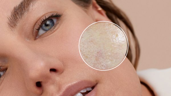 Tham khảo các bước chăm sóc da dầu nhạy cảm hiệu quả