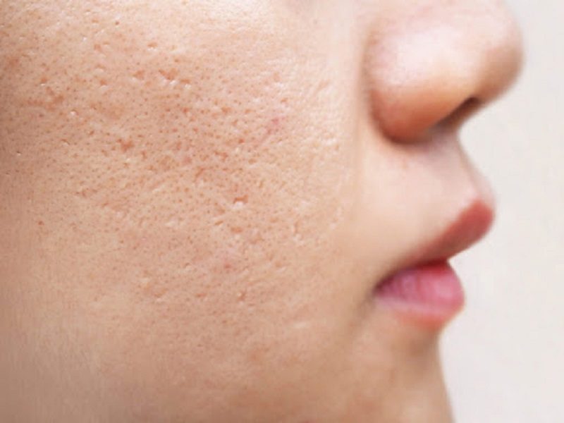 Tìm hiểu nguyên nhân để biết cách khắc phục lỗ chân lông to ở mặt