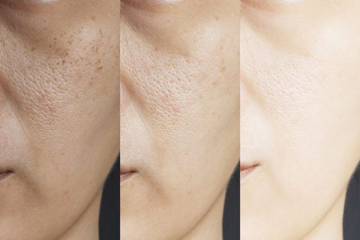 Những cách khắc phục lỗ chân lông to ở mặt phổ biến hiện nay