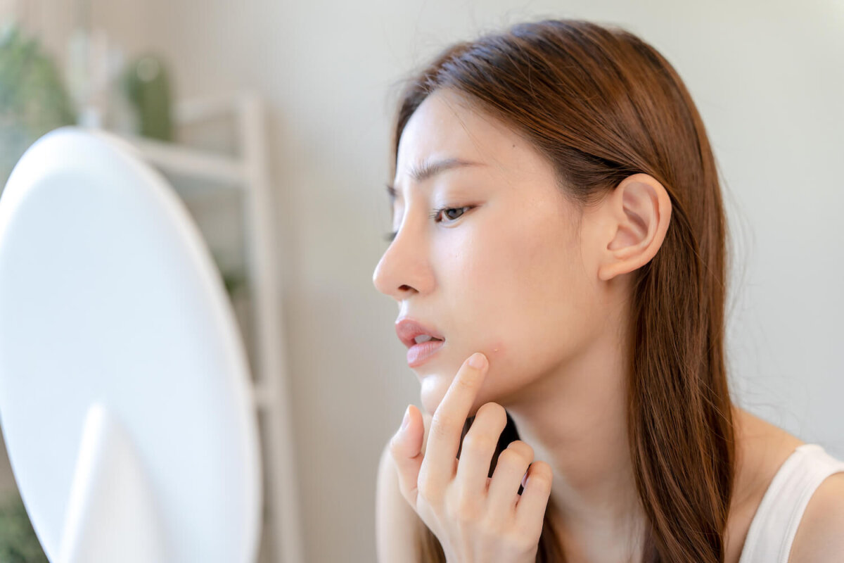 Tìm hiểu nguyên nhân để có cách skincare cho da mụn tuổi dậy thì phù hợp
