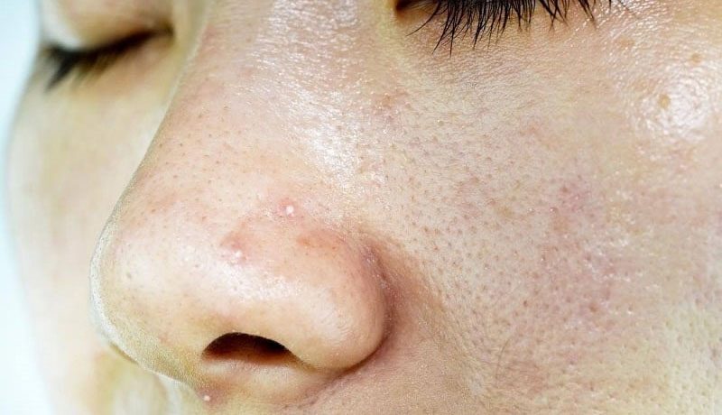 Nguyên nhân nào khiến da dầu và lỗ chân lông to