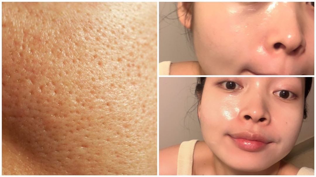 Hiểu rõ nguyên nhân để có cách trị lỗ chân lông to hiệu quả