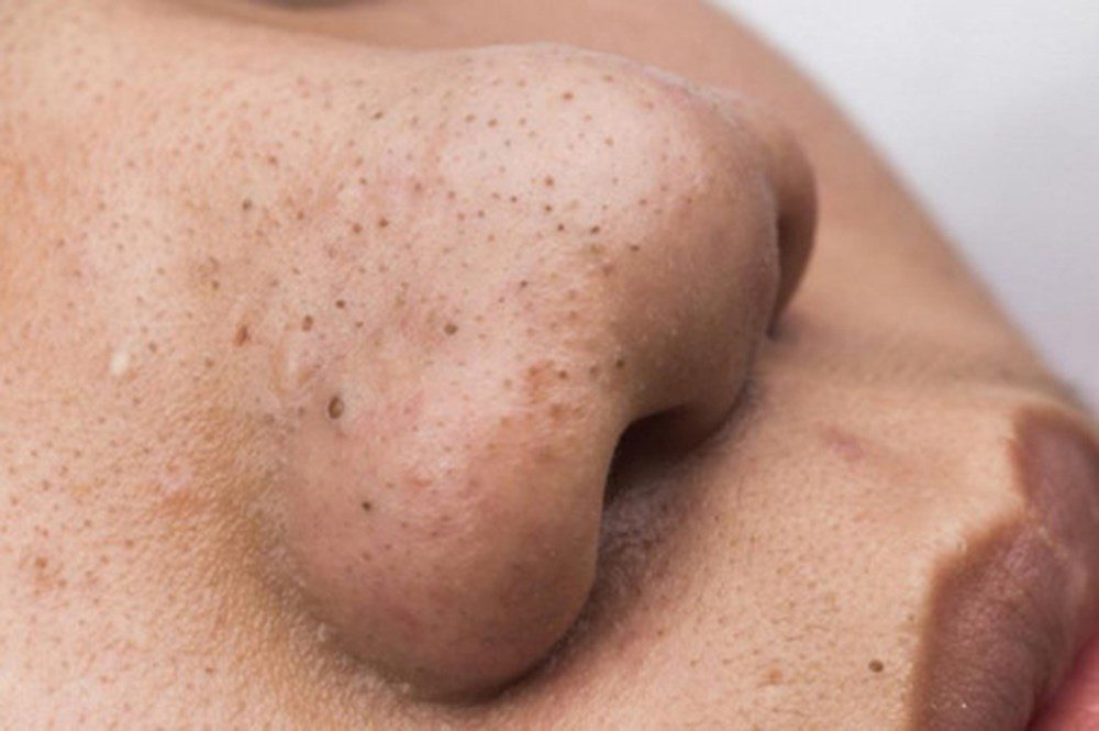 Hiểu rõ nguyên nhân để biết cách trị mụn đầu đen và lỗ chân lông to