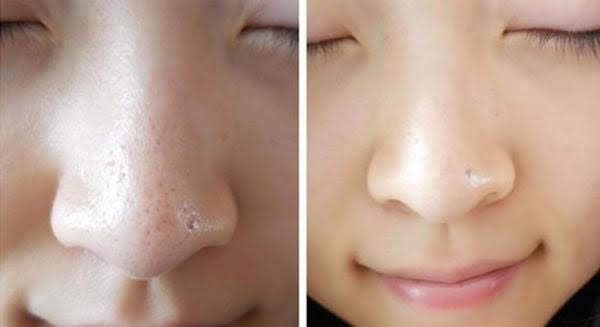 Cải thiện lỗ chân lông to ở mặt sau cạo lông với sản phẩm Dr.Spiller