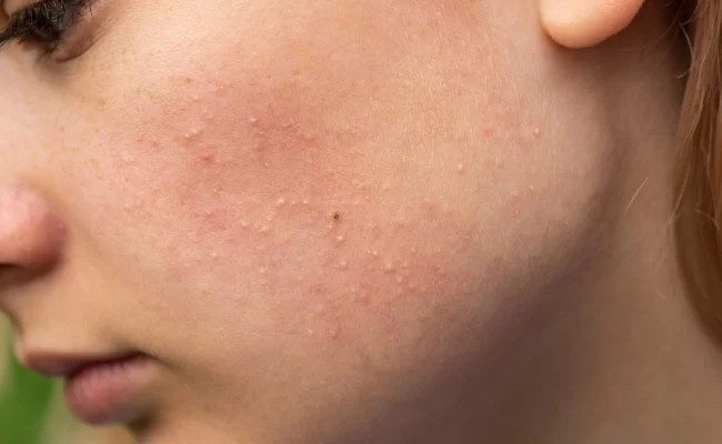 Hiểu rõ nguyên nhân để biết cách chăm sóc da hỗn hợp bị mụn ẩn