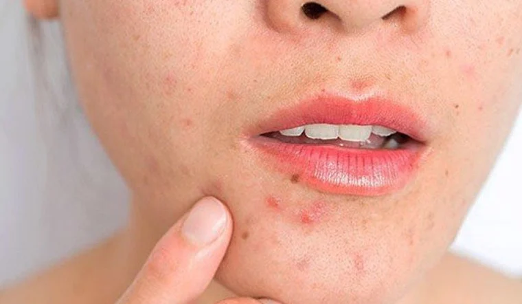 Những lưu ý khi chăm sóc da hỗn hợp vào mùa đông