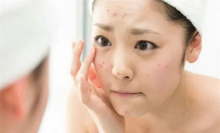 Tại sao da dễ nổi mụn vào mùa hè? Chăm sóc da mụn mùa hè sao cho hợp lý