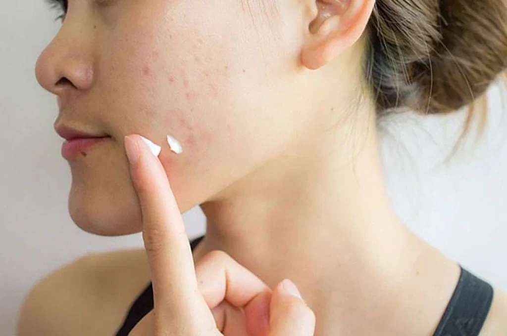 Những lưu ý khi chọn combo trị mụn cho da dầu giá rẻ