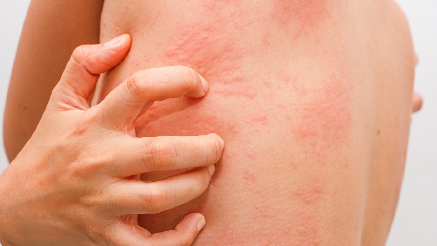 Tìm hiểu nguyên nhân da dị ứng ánh nắng mùa hè và cách phục hồi hiệu quả