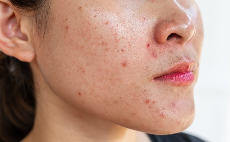 Phương pháp chăm sóc da dầu bít tắc lỗ chân lông giúp ngăn ngừa mụn hiệu quả