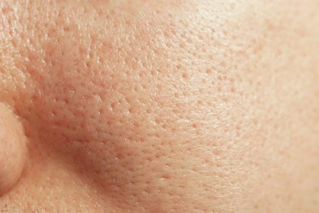 Tuyến bã nhờn hoạt động quá mức là một trong những nguyên nhân khiến da dầu bị bít tắc lỗ chân lông