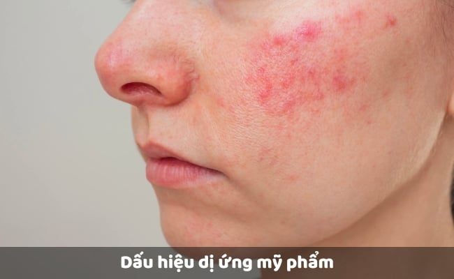 Thăm khám chuyên gia nếu da dầu bị dị ứng mỹ phẩm dẫn đến kích ứng nặng