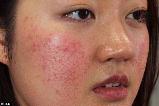 Tìm hiểu nguyên nhân da dầu bị dị ứng mỹ phẩm