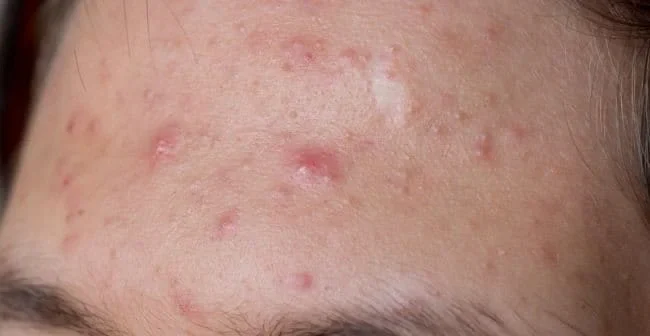 Hiểu rõ nguyên nhân để biết da dầu bị mụn viêm nên dùng gì