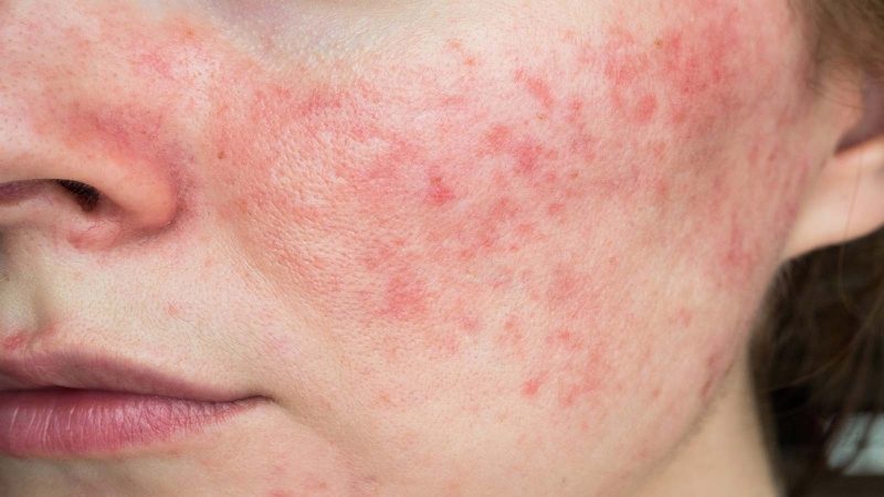 Nhận biết dấu hiệu da dầu nhạy cảm dễ kích ứng