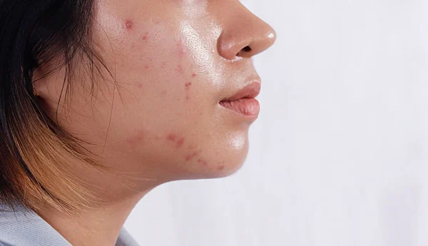 Da hỗn hợp có bị mụn không? Cách chăm sóc da mụn hiệu quả