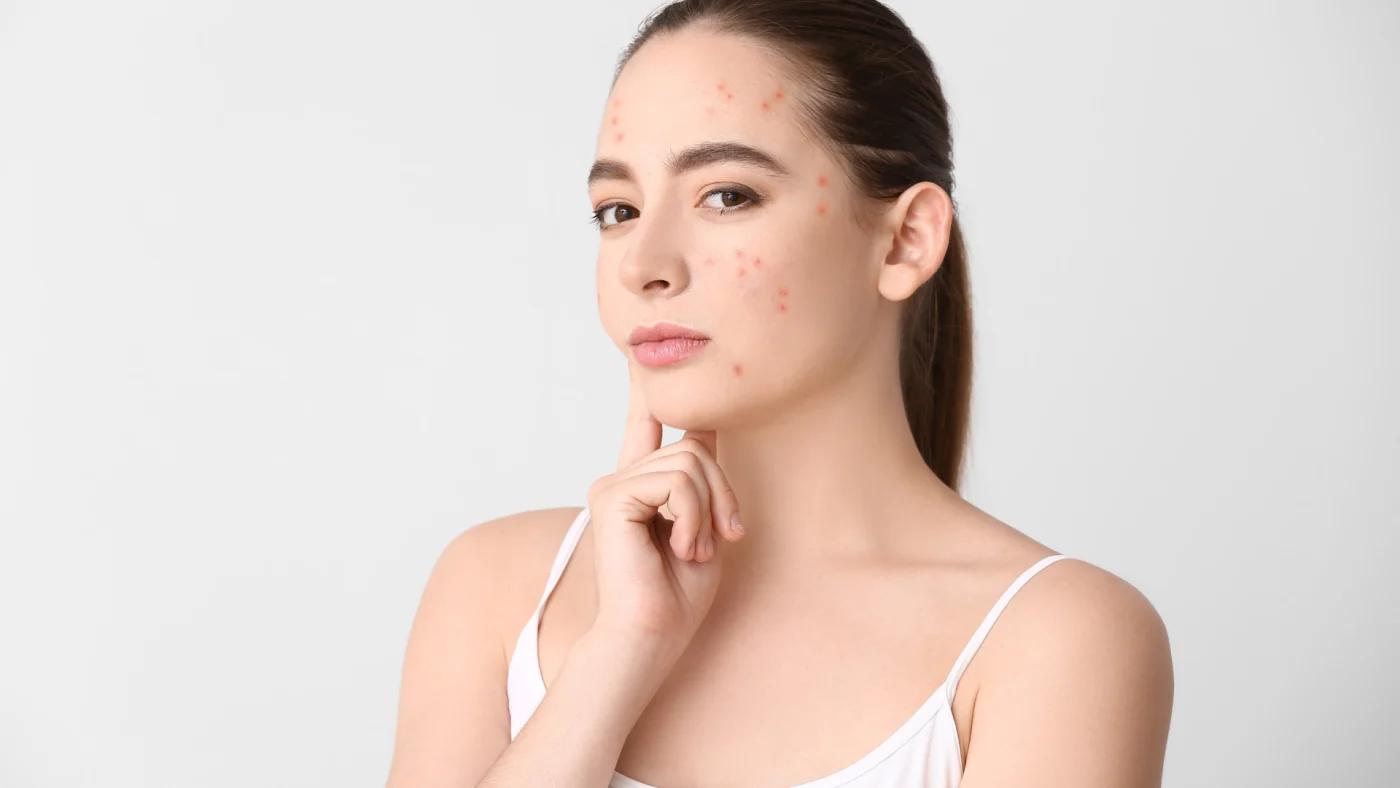 Hiểu rõ làn da để biết da hỗn hợp thiên dầu nên đắp mặt nạ gì