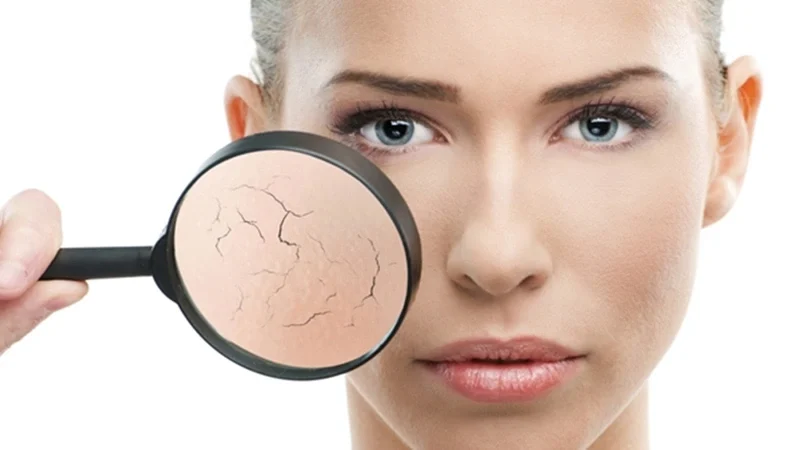 Hiểu rõ nguyên nhân da khô để biết da khô có nên dùng dầu dưỡng không