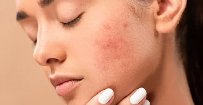 Những sai lầm phổ biến khi xử lý da khô do dị ứng mỹ phẩm