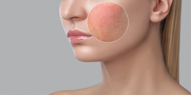 Dấu hiệu nhận biết nguyên nhân da khô do dị ứng mỹ phẩm