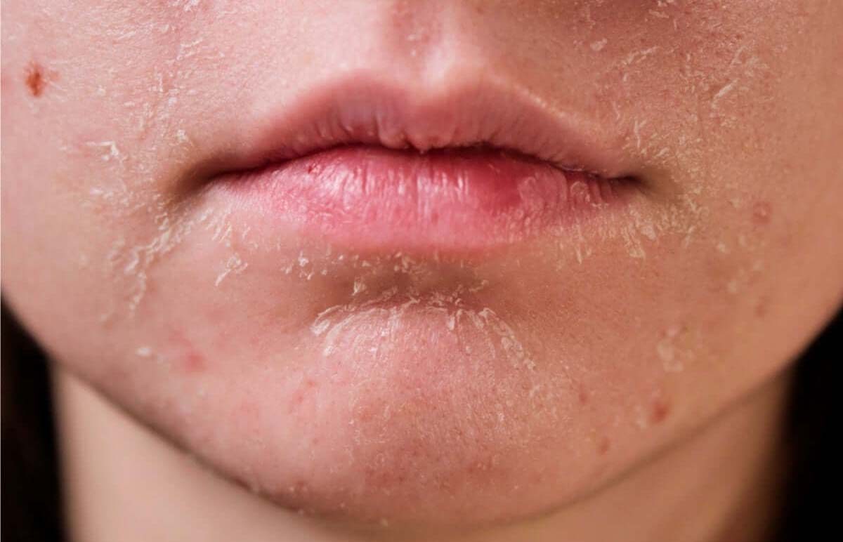 Tìm hiểu nguyên nhân da khô do dùng retinol