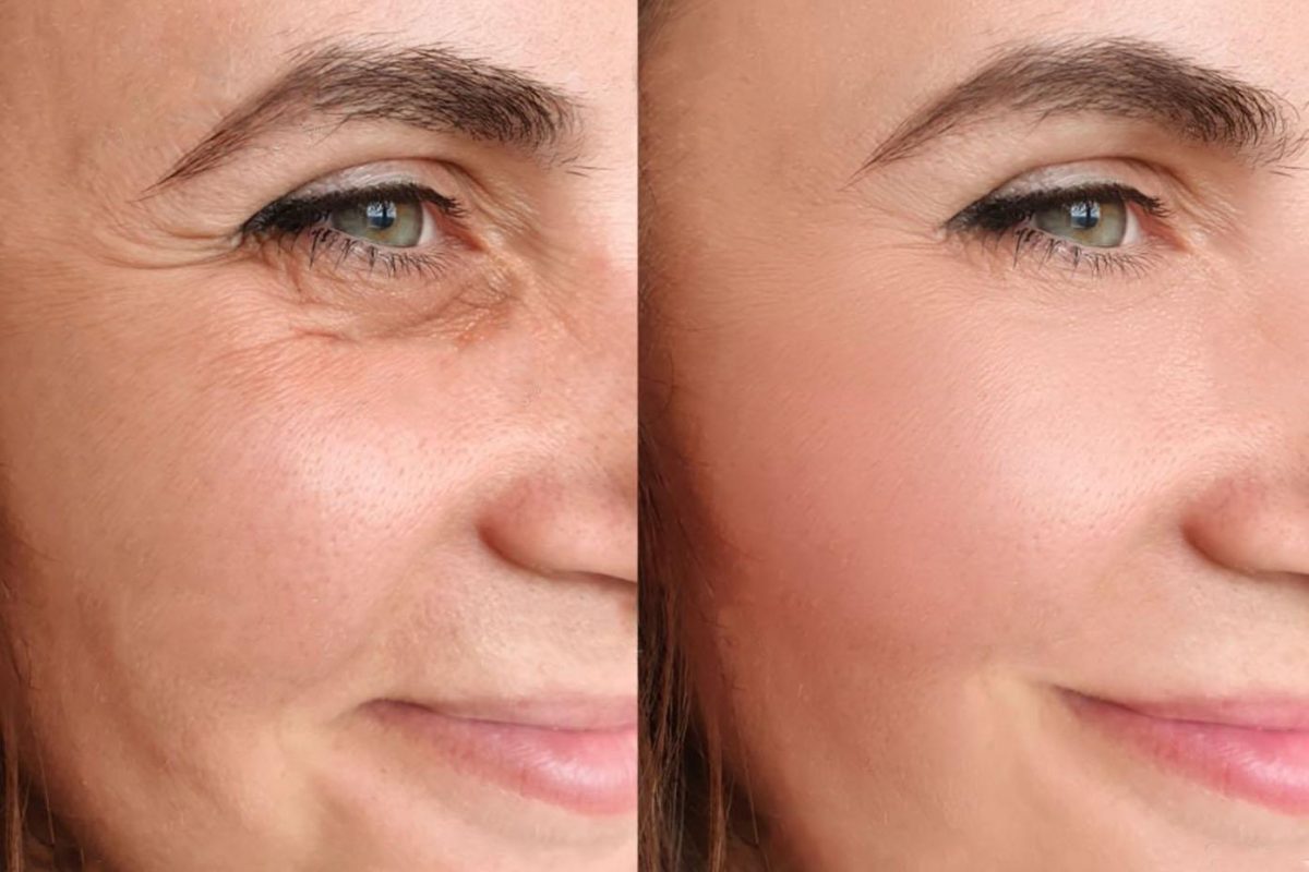 Da khô do thiếu collagen nếu không được khắc phục sẽ dẫn đến lão hóa