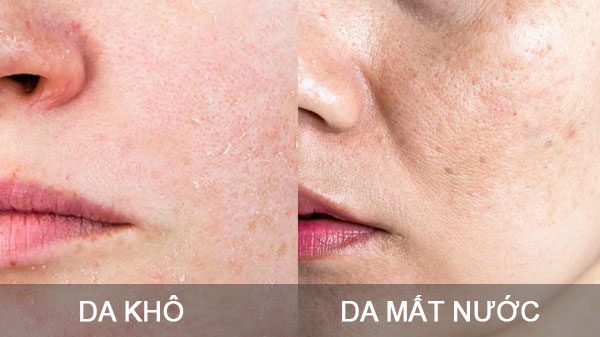 Phân biệt da khô do thiếu nước hay thiếu dầu
