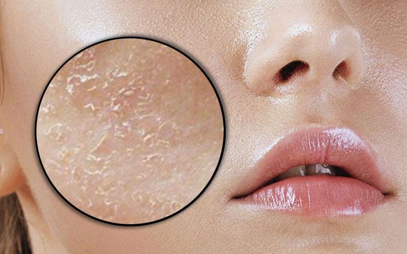 Nguyên tắc chăm sóc da khô do thiếu nước hay thiếu dầu