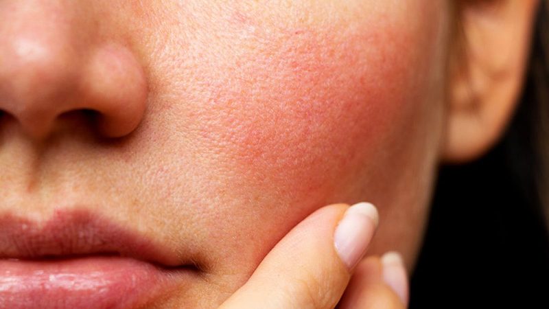 Cải thiện làn da khô ngứa từ bên trong với chế độ sinh hoạt lành mạnh