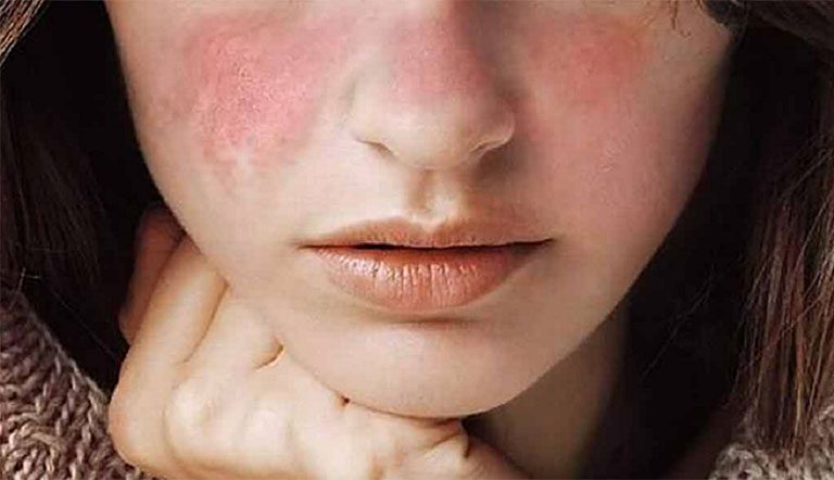 Những nguyên nhân khiến da khô nổi mẩn đỏ