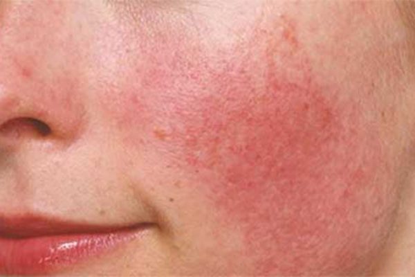 Điều chỉnh thói quen sinh hoạt có giúp giảm tình trạng da khô nổi mẩn đỏ